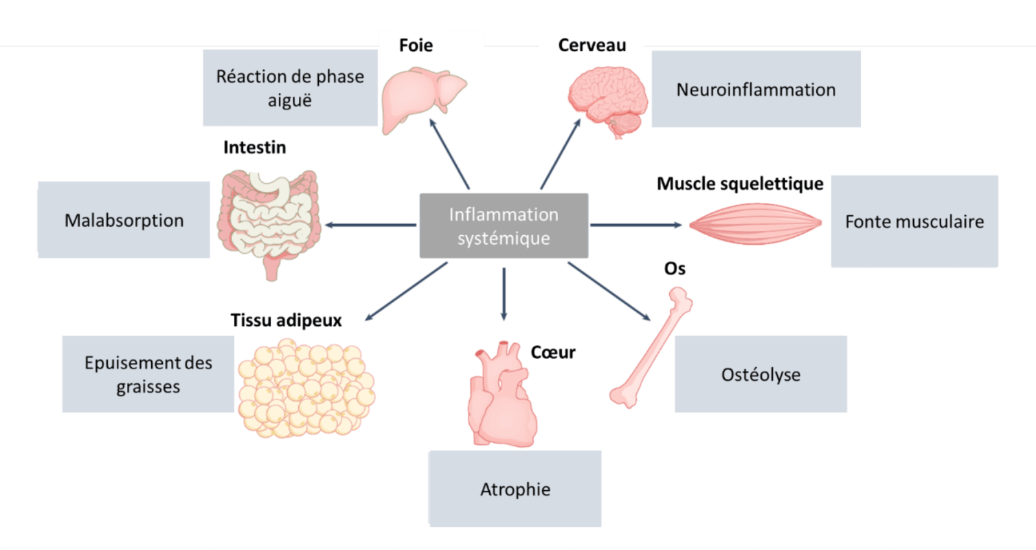 Cachexie Les Origines cancer Et Autres Pathologies Nutrisens cachexie-les-origines-cancer-et-autres-pathologies-nutrisens