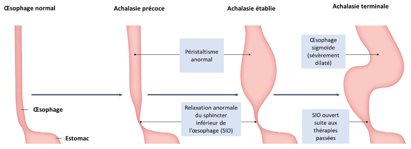 Figure 1 : Manifestations œsophagiennes et évolution de l’achalasie (d’après Savarino et al. 2022).
