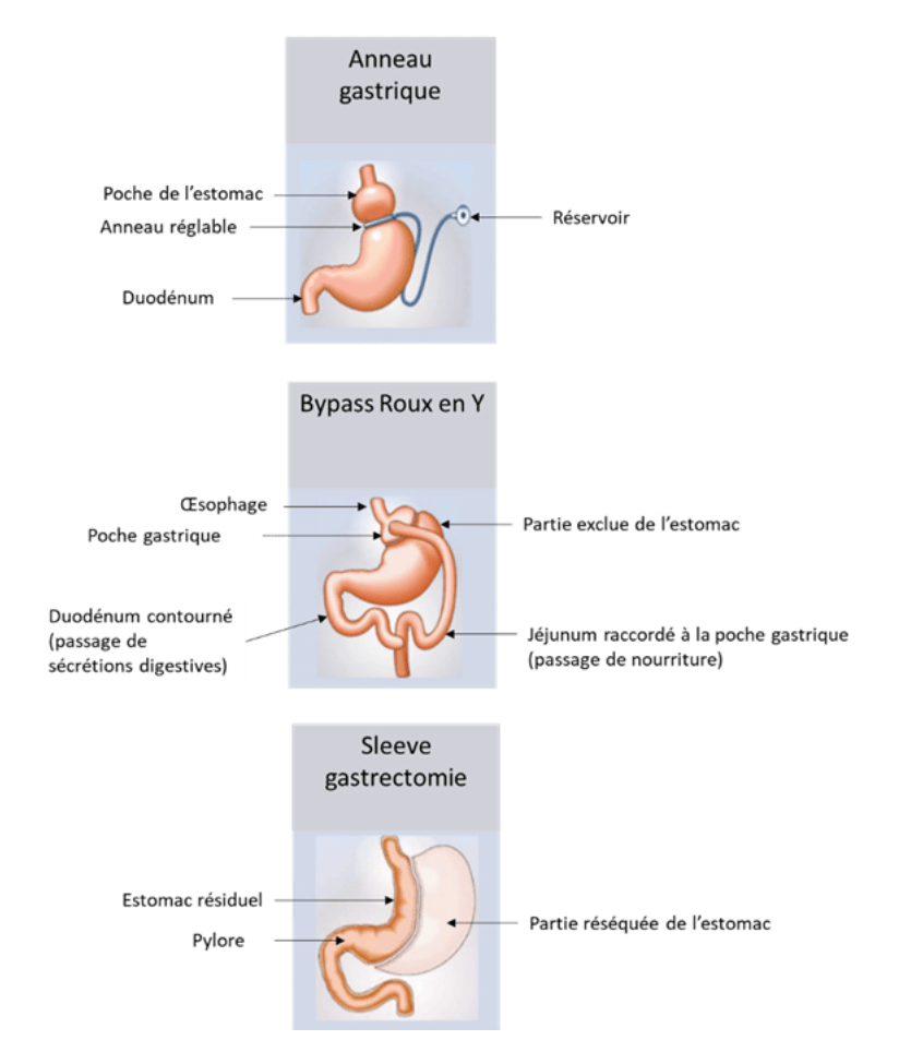 Représentation schématique de trois types d’interventions : l’anneau gastrique, le bypass Roux en Y et la sleeve gastrectomie
